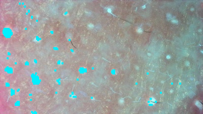 毛穴・角栓解析